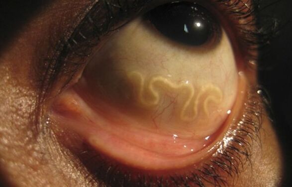 Robak Loa Loa żyje w ludzkim oku i powoduje ślepotę